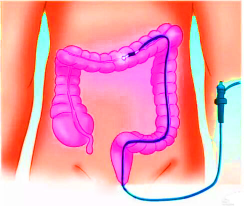 直腸癌早期有哪些癥狀？